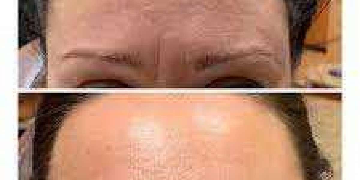Botox For Forehead Wrinkles